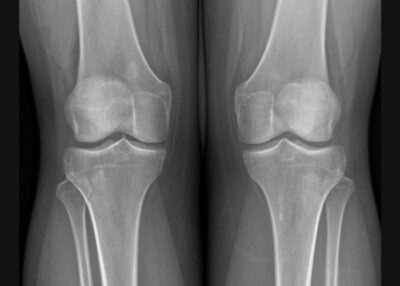 Robotic Knee Replacement | Total Knee Arthroplasty (TKA) | Knee Surgeon ...